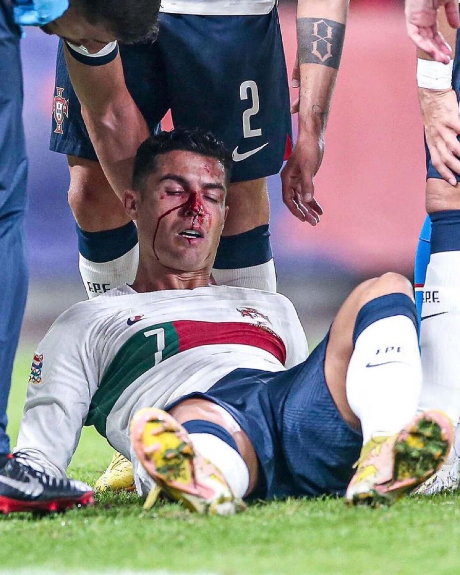 Cristiano Ronaldo Suffering a Nose Injury, Date Unknown